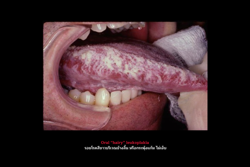 Oral hairy leukoplakia