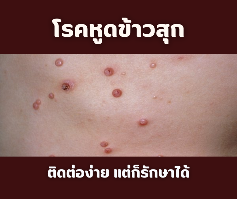 โรคหูดข้าวสุก ติดต่อง่าย แต่ก็รักษาได้